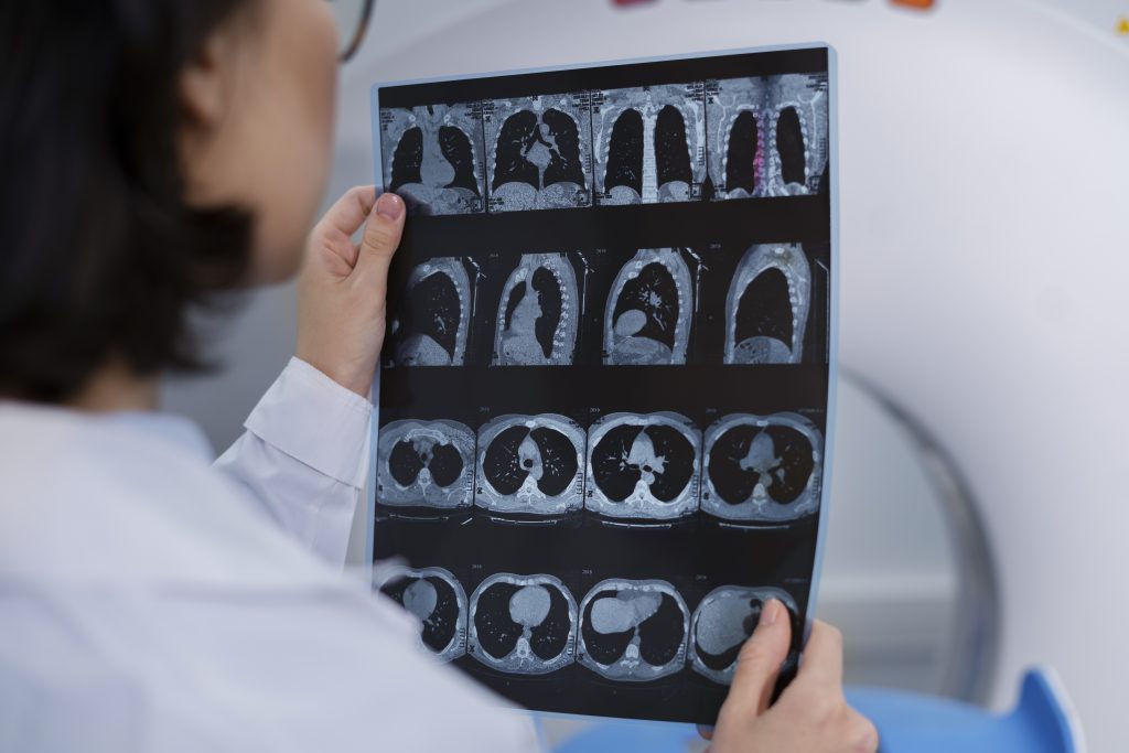 低劑量電腦掃描能篩查早期肺癌