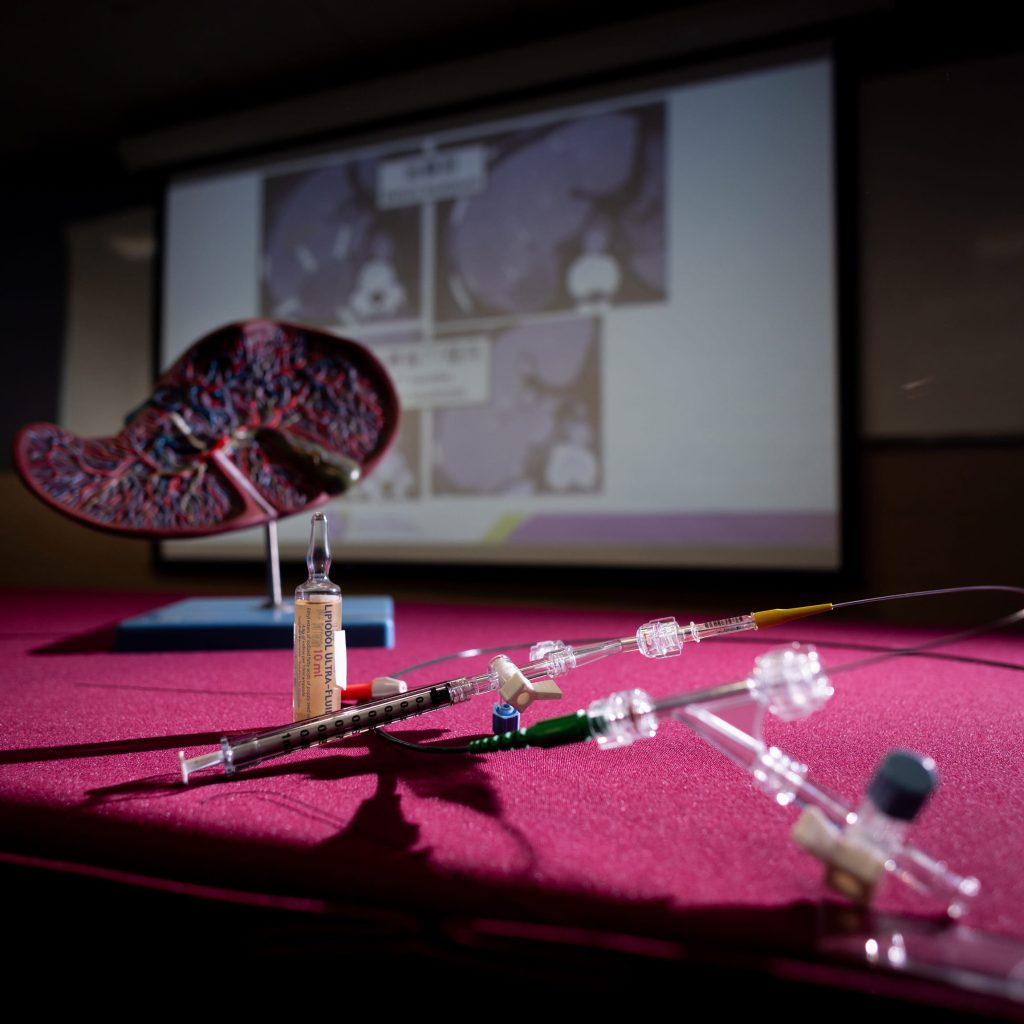 新配方改以無水純化療藥「順鉑」配合碘化油，經導管送入腫瘤血管，並以明膠微粒將供應腫瘤的肝臟血管栓塞， 藉此阻截腫瘤的血液供應，令癌細胞死亡。